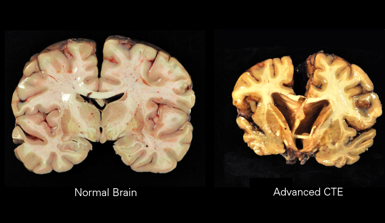 Understanding Chronic Traumatic Encephalopathy (CTE) and Its Implications