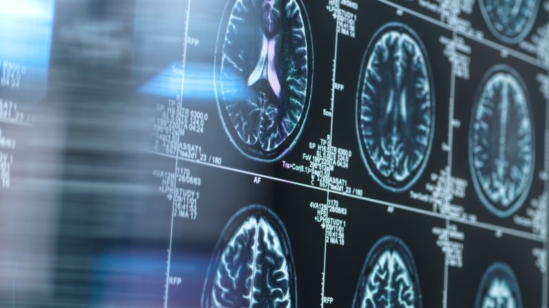 Potential Breakthrough in Alzheimer's Research Revealed by Harvard Scientists