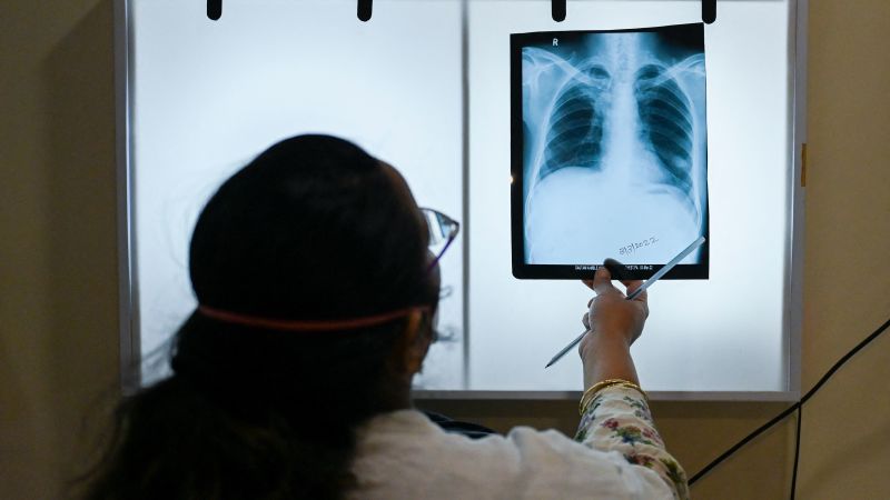 Challenges in Eradicating Tuberculosis in Mumbai Suburb